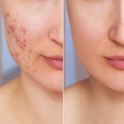Exemplo ilustrativo de Tratamento da Acne