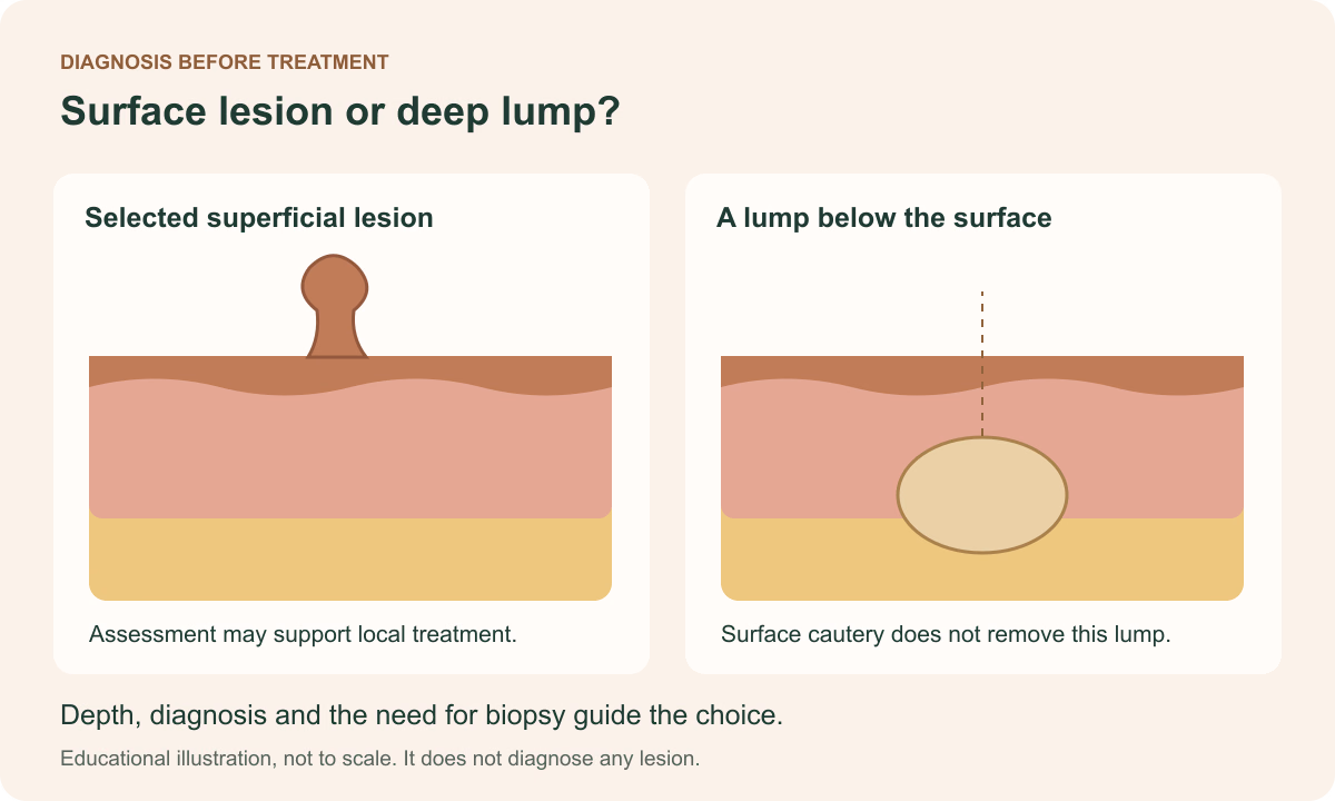 Side-by-side skin cross sections illustrate why lesion depth affects treatment choice.