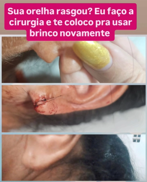 Lobuloplastia antes e depois