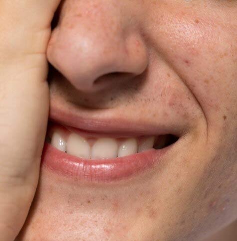Illustrative image about dark spots and melasma