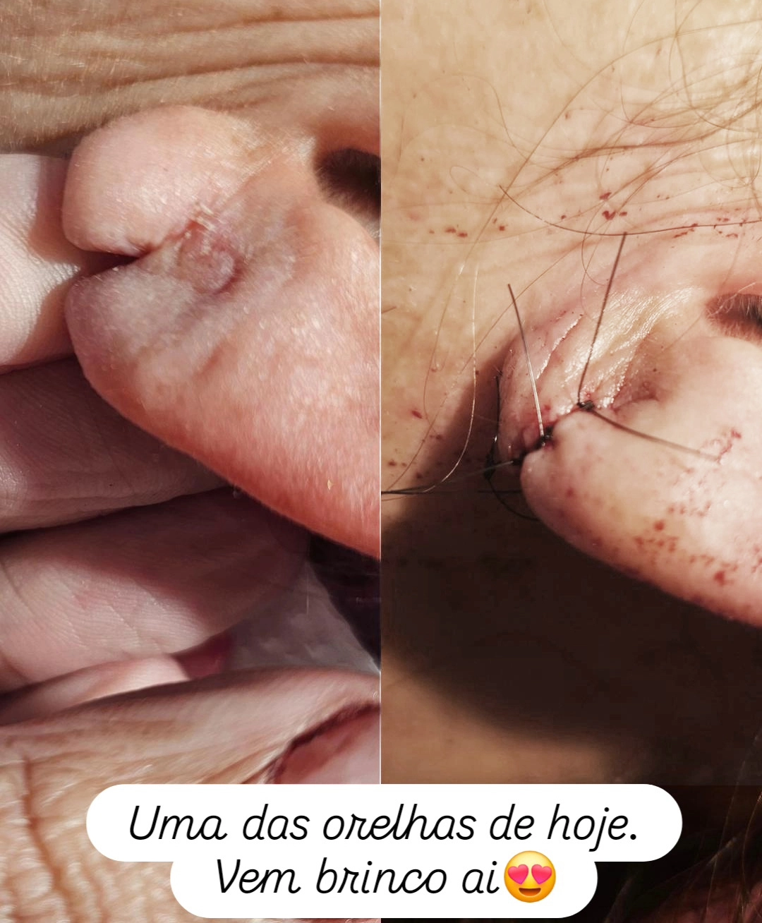 Resultado da Otoplastia - antes e depois