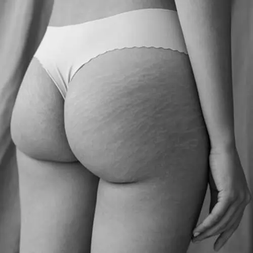 Illustrative image about stretch marks and skin quality